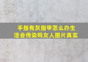 手指有灰指甲怎么办生活会传染吗女人图片真实