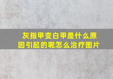 灰指甲变白甲是什么原因引起的呢怎么治疗图片