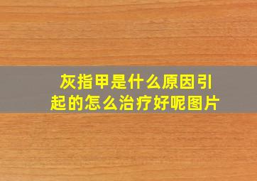 灰指甲是什么原因引起的怎么治疗好呢图片