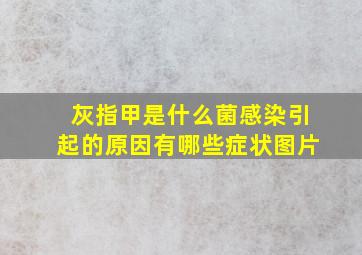 灰指甲是什么菌感染引起的原因有哪些症状图片