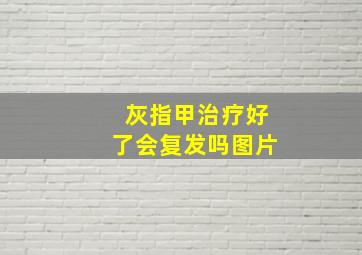 灰指甲治疗好了会复发吗图片