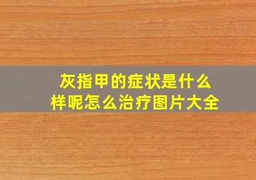 灰指甲的症状是什么样呢怎么治疗图片大全