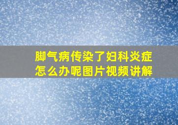 脚气病传染了妇科炎症怎么办呢图片视频讲解