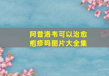 阿昔洛韦可以治愈疱疹吗图片大全集