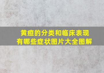 黄疸的分类和临床表现有哪些症状图片大全图解