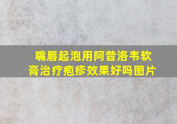 嘴唇起泡用阿昔洛韦软膏治疗疱疹效果好吗图片