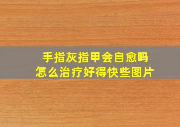 手指灰指甲会自愈吗怎么治疗好得快些图片