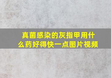 真菌感染的灰指甲用什么药好得快一点图片视频